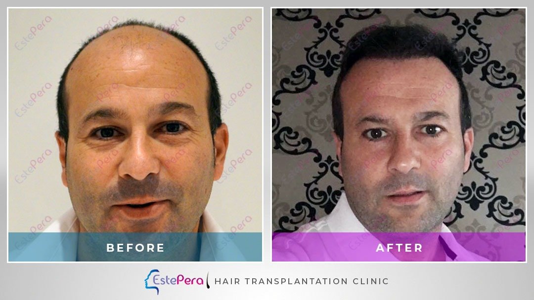 EstePera Hair Transplant Turkey - EstePera Hair Transplant Turkey