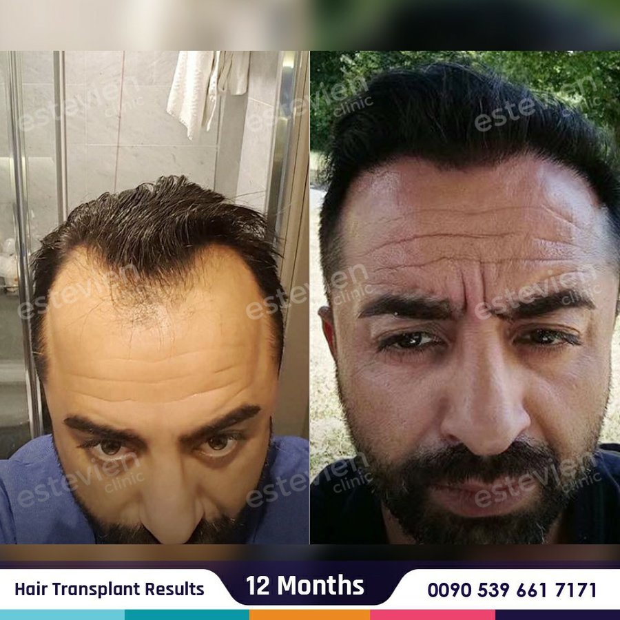Estevien Clinic - Dr Esin / Hair Transplant - Estevien Clinic - Dr Esin / Hair Transplant