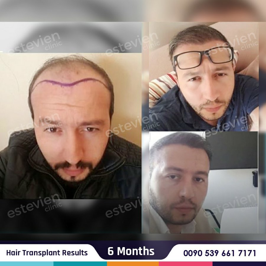 Estevien Clinic - Dr Esin / Hair Transplant - Estevien Clinic - Dr Esin / Hair Transplant