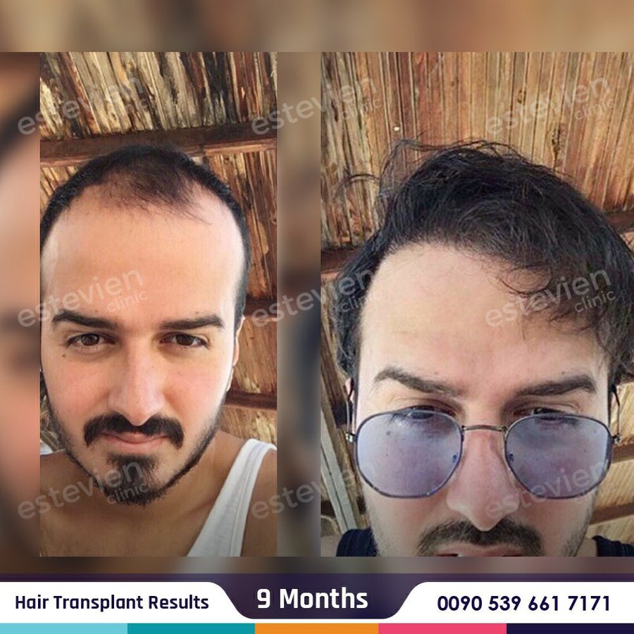 Estevien Clinic - Dr Esin / Hair Transplant - Estevien Clinic - Dr Esin / Hair Transplant