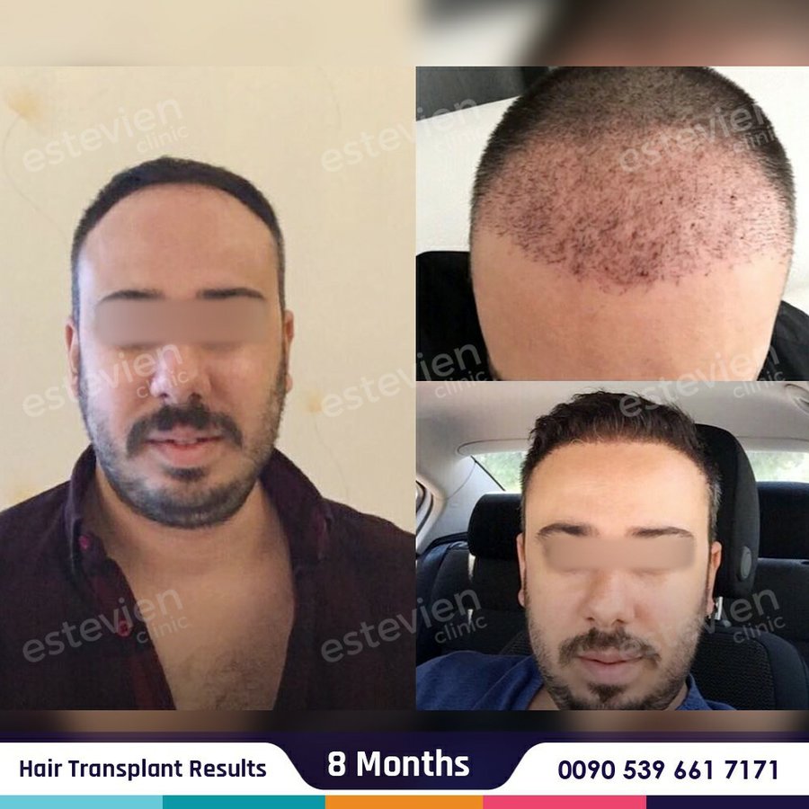 Estevien Clinic - Dr Esin / Hair Transplant - Estevien Clinic - Dr Esin / Hair Transplant