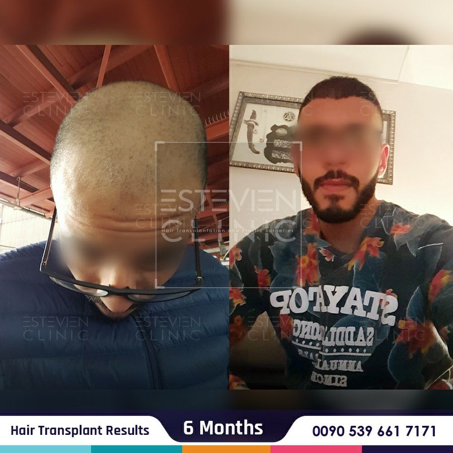 Estevien Clinic - Dr Esin / Hair Transplant - Estevien Clinic - Dr Esin / Hair Transplant