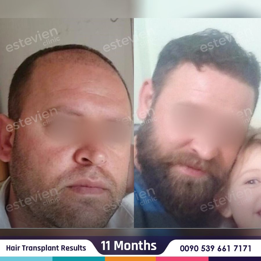 Estevien Clinic - Dr Esin / Hair Transplant - Estevien Clinic - Dr Esin / Hair Transplant