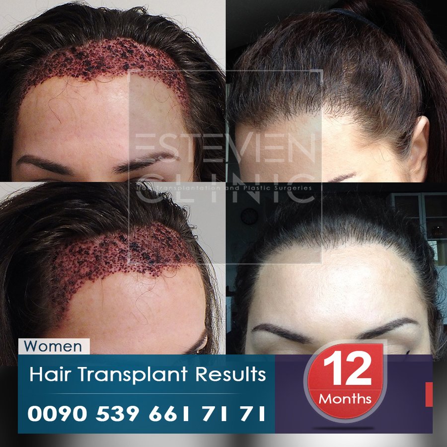 Estevien Clinic - Dr Esin / Hair Transplant - Estevien Clinic - Dr Esin / Hair Transplant