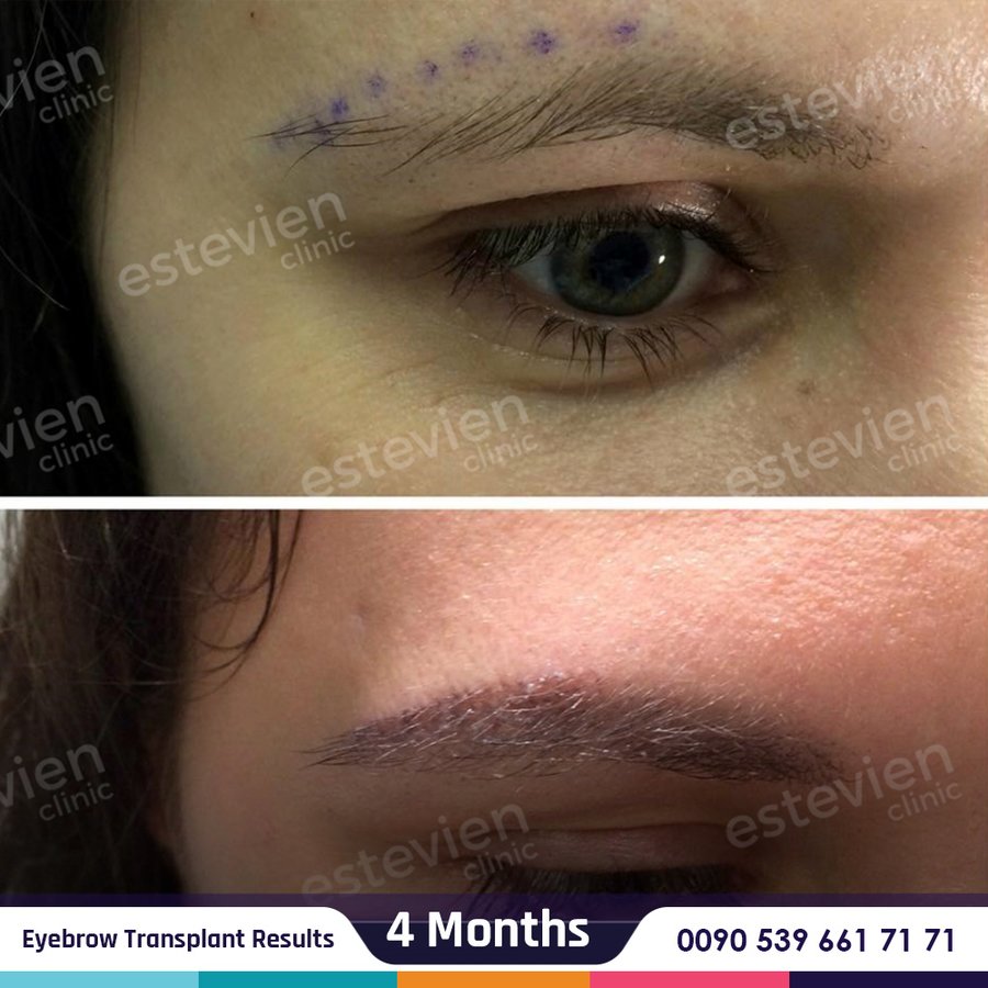 Estevien Clinic - Dr Esin / Hair Transplant - Estevien Clinic - Dr Esin / Hair Transplant