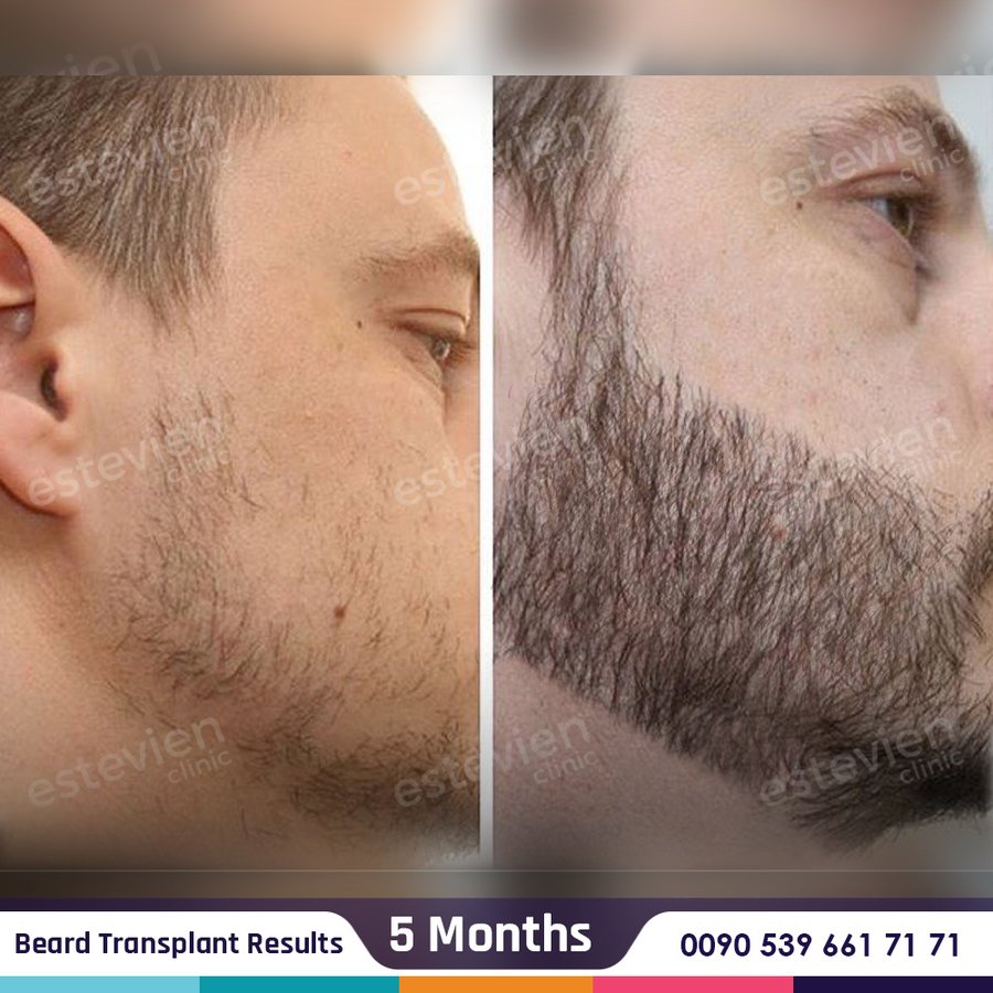 Estevien Clinic - Dr Esin / Hair Transplant - Estevien Clinic - Dr Esin / Hair Transplant