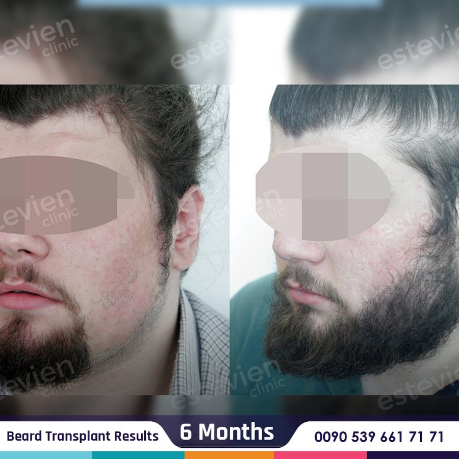 Estevien Clinic - Dr Esin / Hair Transplant - Estevien Clinic - Dr Esin / Hair Transplant