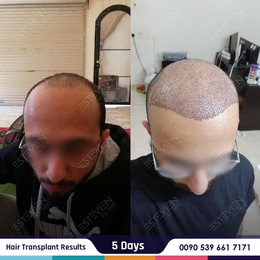 Estevien Clinic - Dr Esin / Hair Transplant - Estevien Clinic - Dr Esin / Hair Transplant