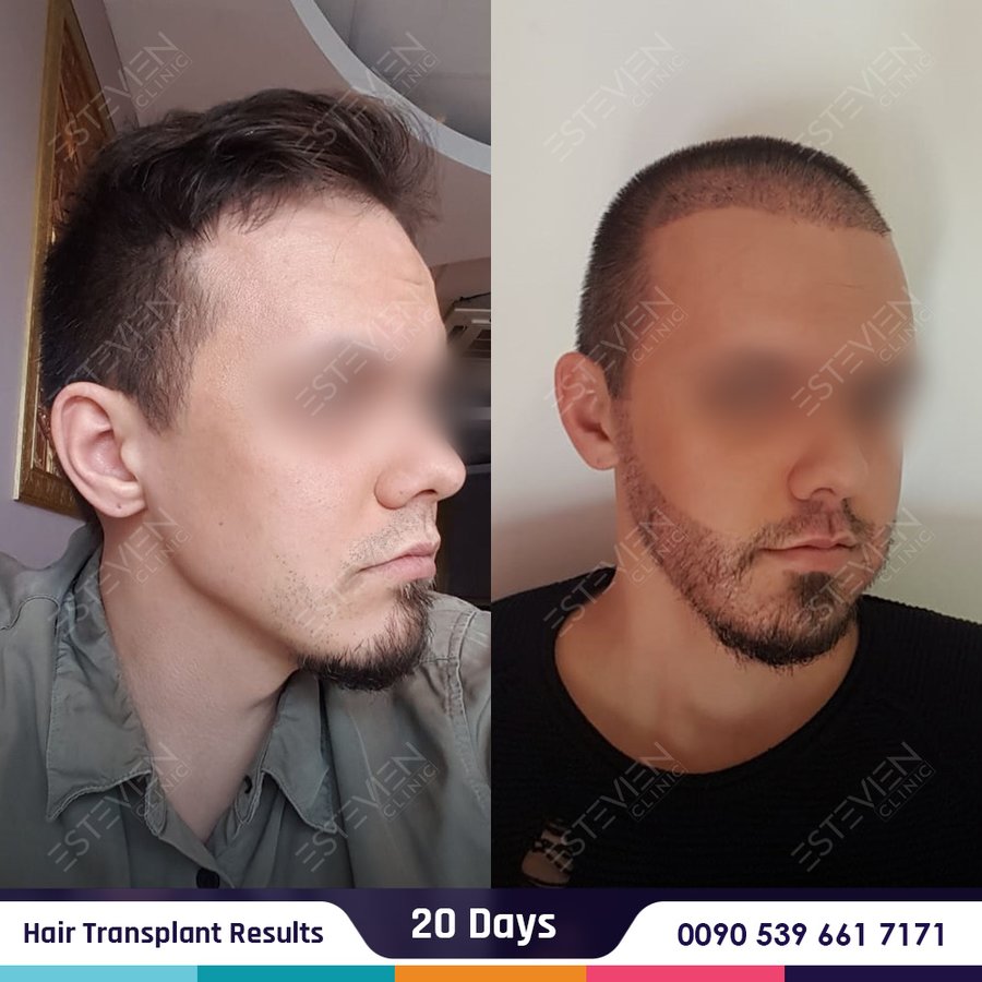 Estevien Clinic - Dr Esin / Hair Transplant - Estevien Clinic - Dr Esin / Hair Transplant