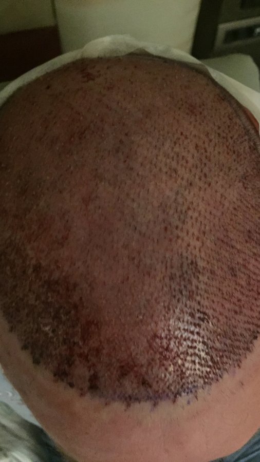 Estevien Clinic - Dr Esin / Hair Transplant - Estevien Clinic - Dr Esin / Hair Transplant