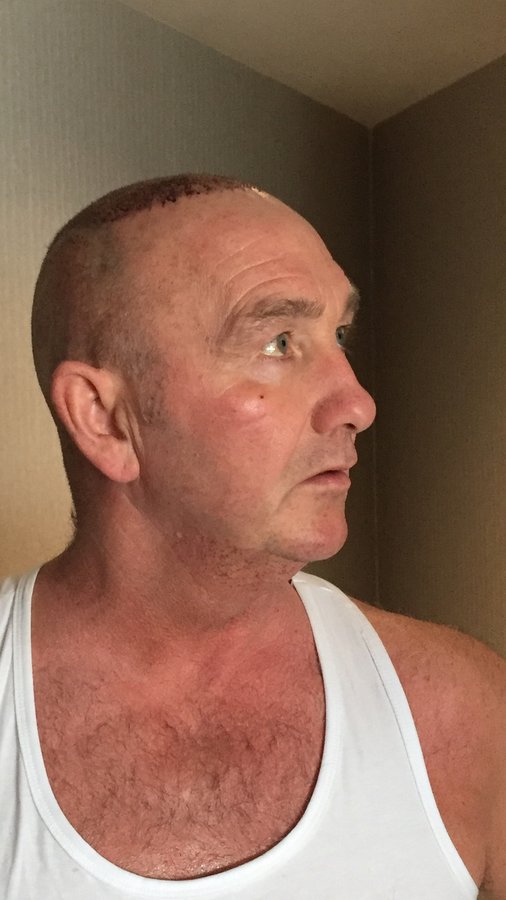 Estevien Clinic - Dr Esin / Hair Transplant - Estevien Clinic - Dr Esin / Hair Transplant