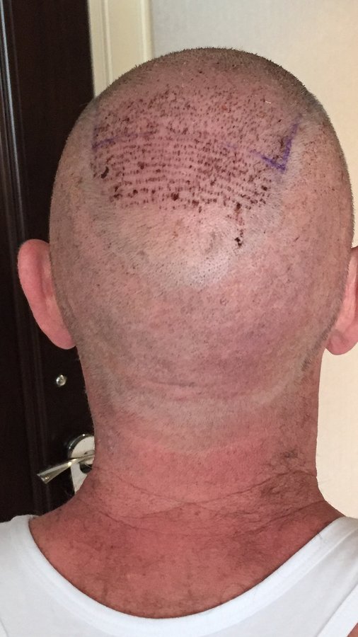 Estevien Clinic - Dr Esin / Hair Transplant - Estevien Clinic - Dr Esin / Hair Transplant