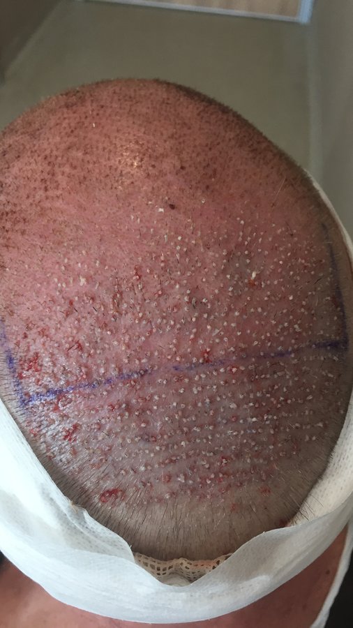 Estevien Clinic - Dr Esin / Hair Transplant - Estevien Clinic - Dr Esin / Hair Transplant