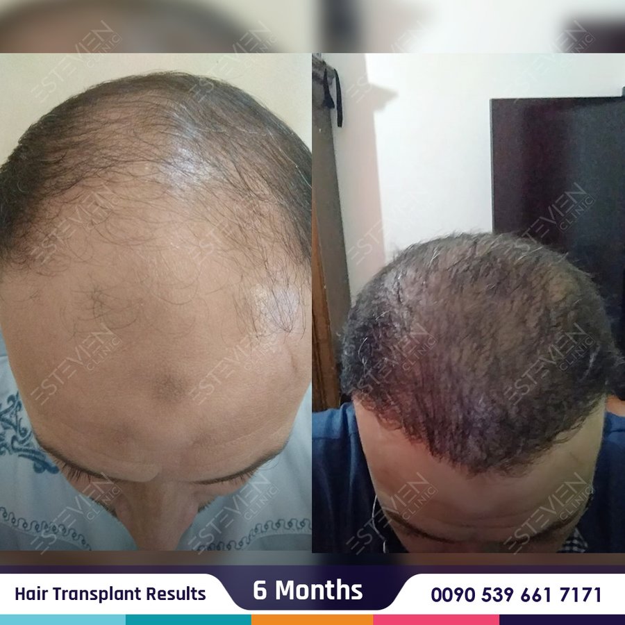 Estevien Clinic - Dr Esin / Hair Transplant - Estevien Clinic - Dr Esin / Hair Transplant