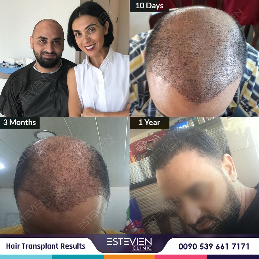 Estevien Clinic - Dr Esin / Hair Transplant - Estevien Clinic - Dr Esin / Hair Transplant