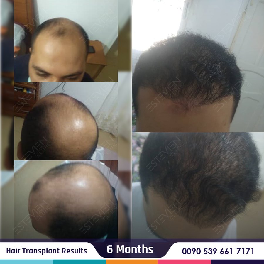 Estevien Clinic - Dr Esin / Hair Transplant - Estevien Clinic - Dr Esin / Hair Transplant