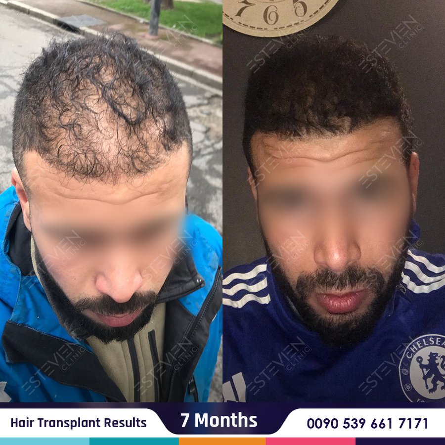 Estevien Clinic - Dr Esin / Hair Transplant - Estevien Clinic - Dr Esin / Hair Transplant