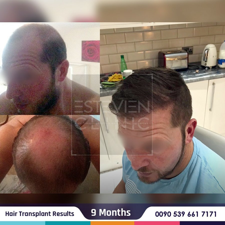Estevien Clinic - Dr Esin / Hair Transplant - Estevien Clinic - Dr Esin / Hair Transplant