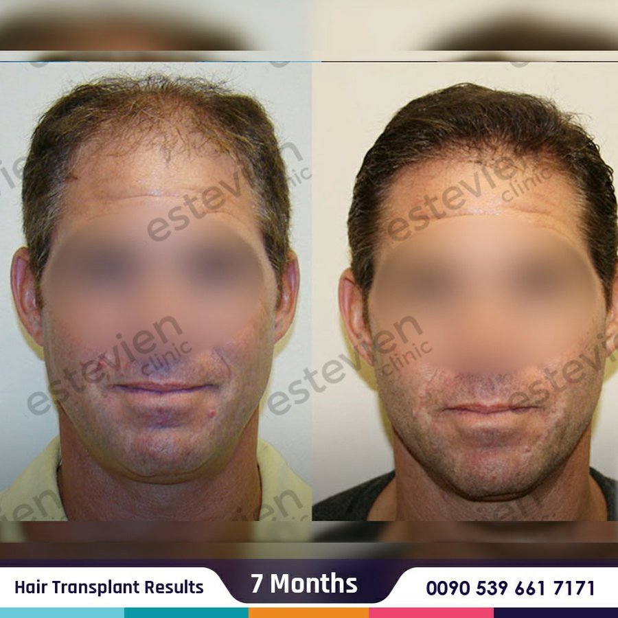Estevien Clinic - Dr Esin / Hair Transplant - Estevien Clinic - Dr Esin / Hair Transplant