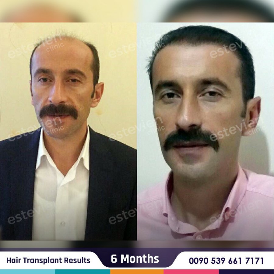 Estevien Clinic - Dr Esin / Hair Transplant - Estevien Clinic - Dr Esin / Hair Transplant