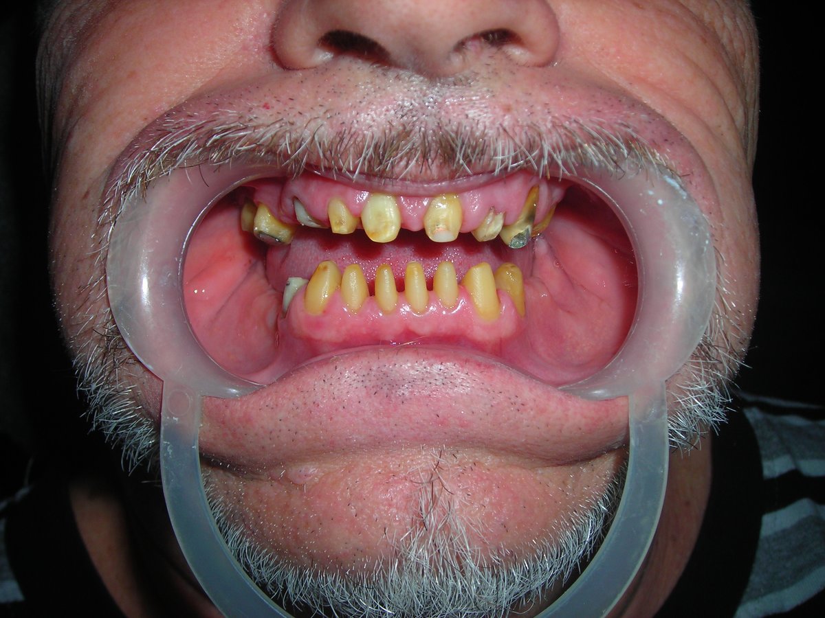 Eversmile Dental Clinic On ONGC Panel - Eversmile Dental Clinic On ONGC Panel