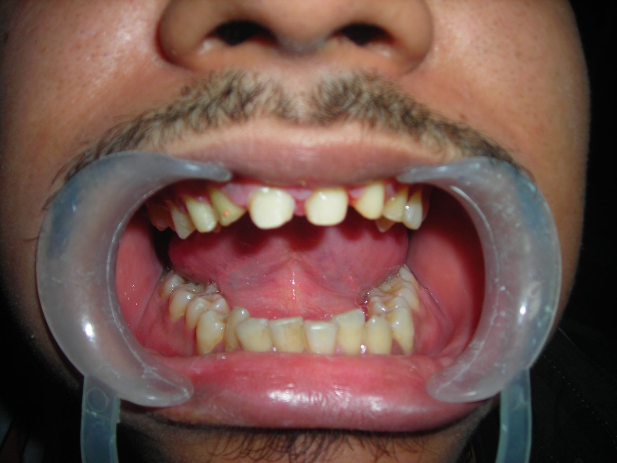 Eversmile Dental Clinic On ONGC Panel - Eversmile Dental Clinic On ONGC Panel