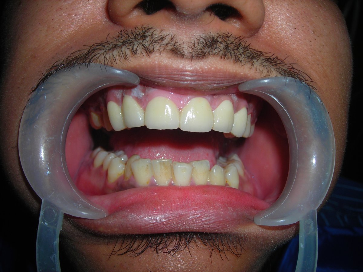 Eversmile Dental Clinic On ONGC Panel - Eversmile Dental Clinic On ONGC Panel