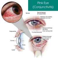 Eye Physicians - Eye Physicians