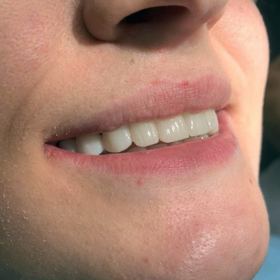 Finesa Dental - Dental Crowns