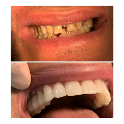 Finesa Dental - Dental Crown before-after