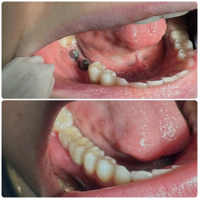 Finesa Dental - Dental Implants