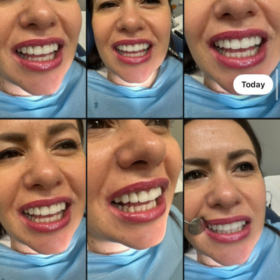 Finesa Dental - Zirconium Crown