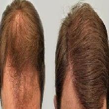 عيادة فورهير لزراعة الشعر - ForHair Hair Transplant Clinic