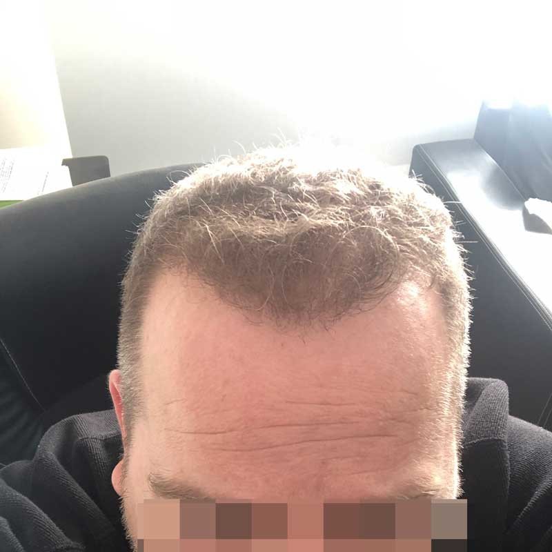 عيادة فورهير لزراعة الشعر - ForHair Hair Transplant Clinic