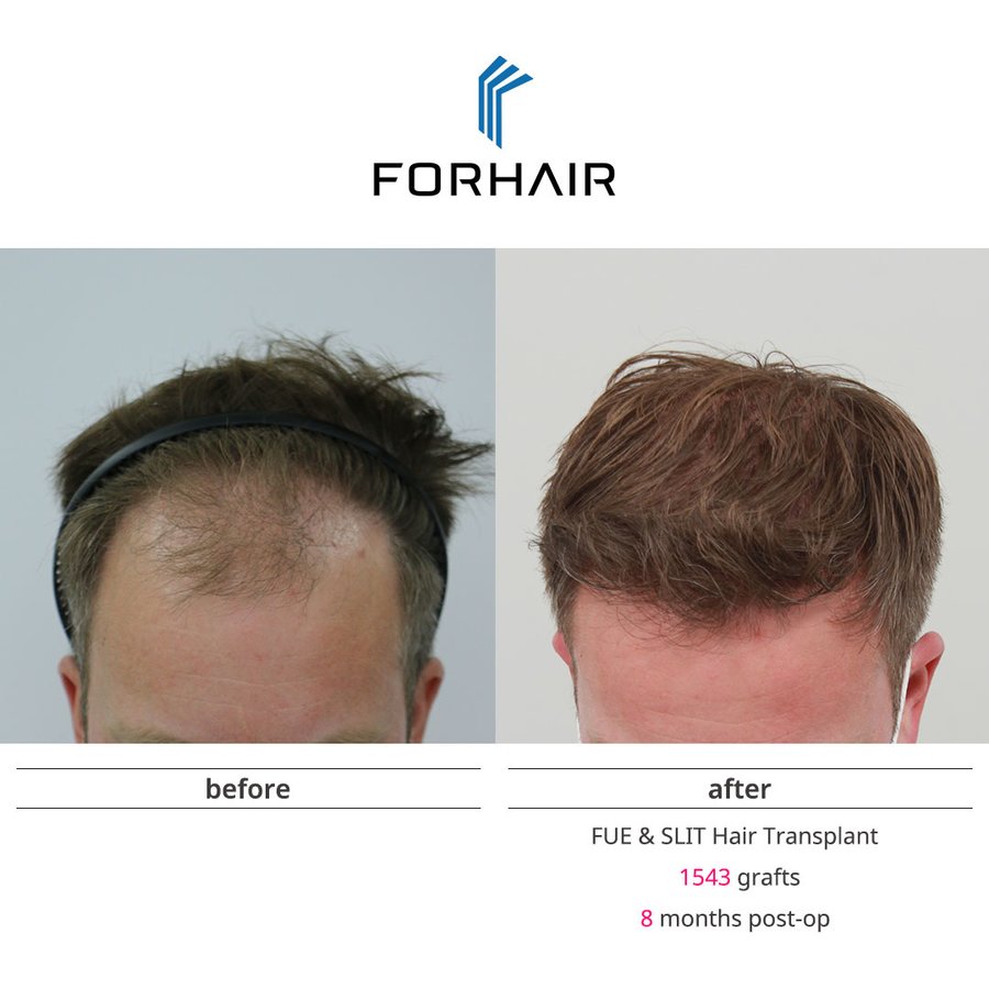 FORHAIR Hair Transplant Korea