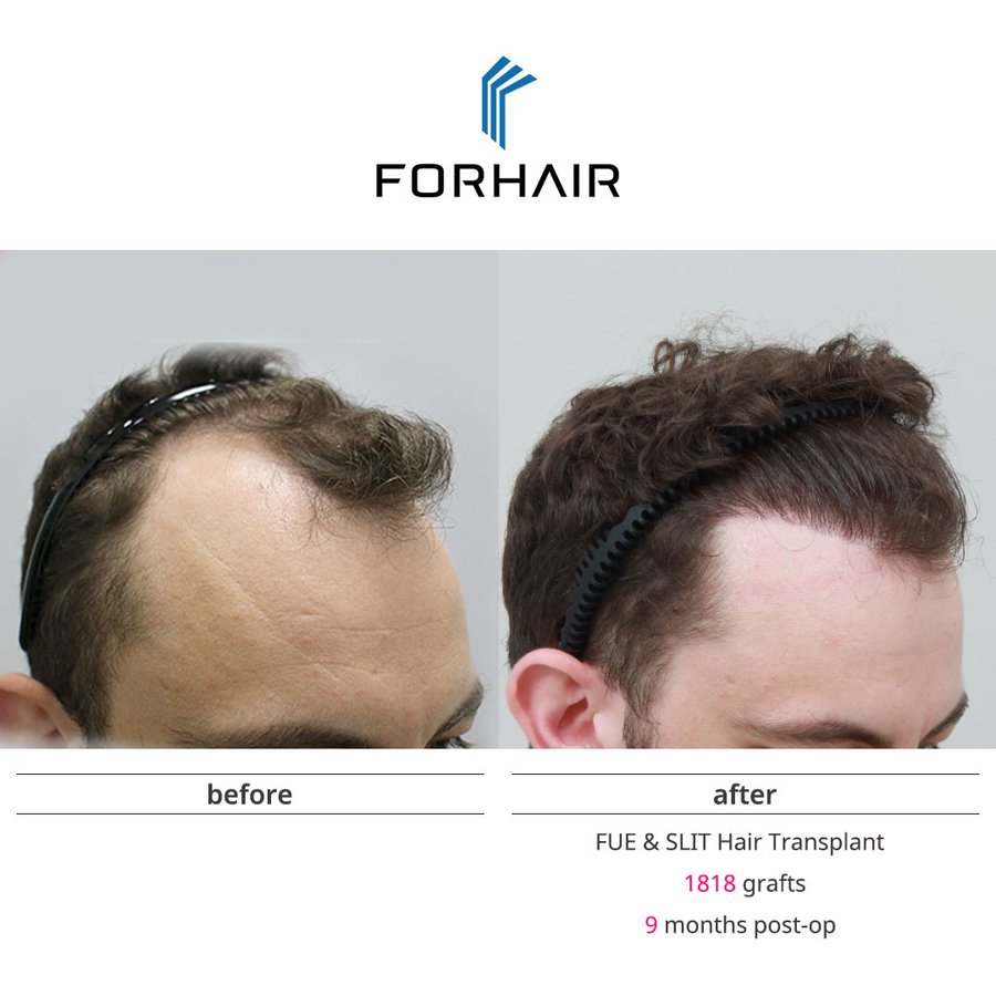 FORHAIR Hair Transplant Korea - FORHAIR Hair Transplant Korea