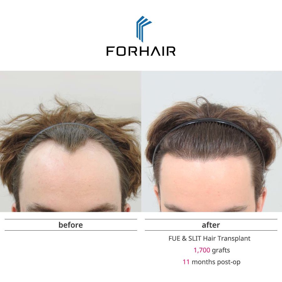 FORHAIR Hair Transplant Korea - FORHAIR Hair Transplant Korea