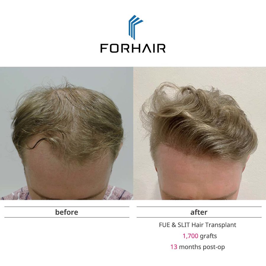 FORHAIR Hair Transplant Korea - FORHAIR Hair Transplant Korea