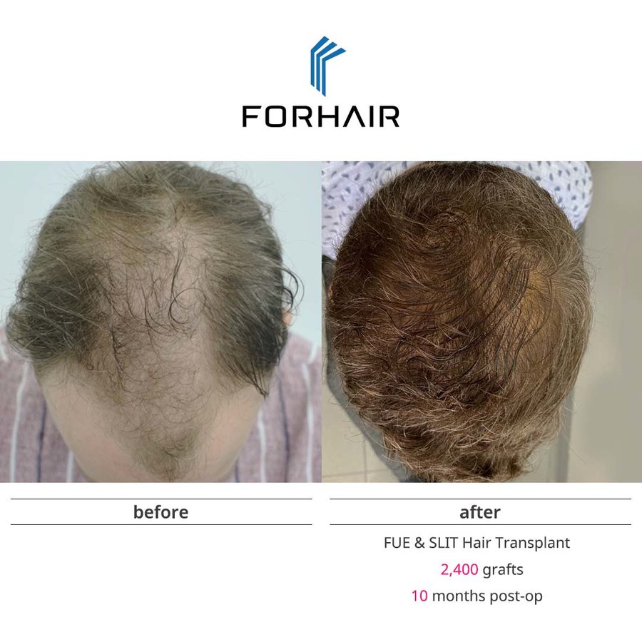 FORHAIR Hair Transplant Korea - FORHAIR Hair Transplant Korea