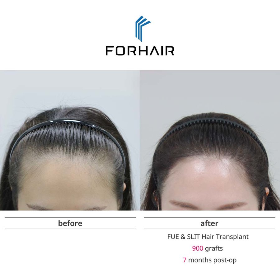 FORHAIR Hair Transplant Korea - FORHAIR Hair Transplant Korea