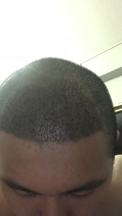 FORHAIR Hair Transplant Korea - FORHAIR Hair Transplant Korea