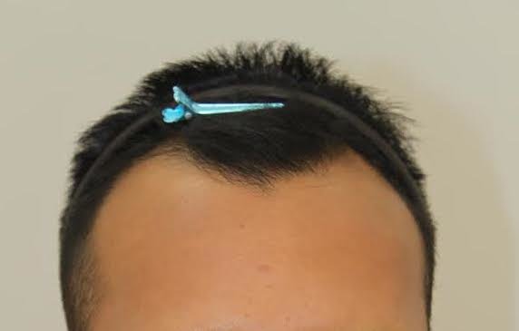 FORHAIR Hair Transplant Korea - FORHAIR Hair Transplant Korea
