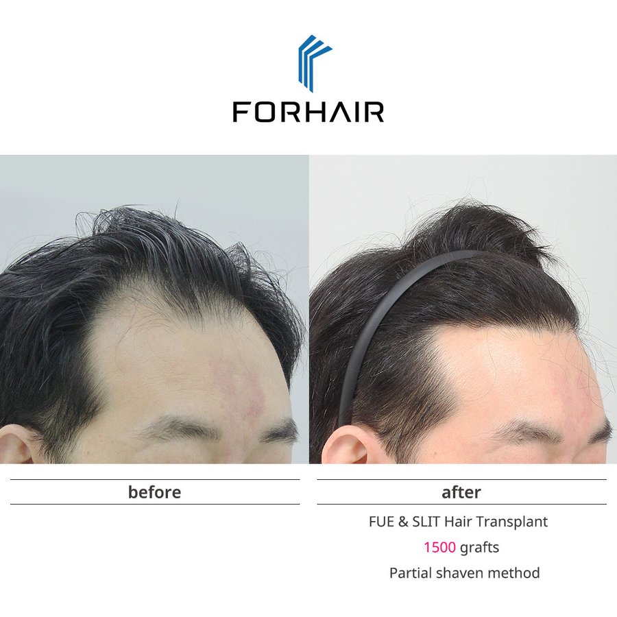 FORHAIR Hair Transplant Korea