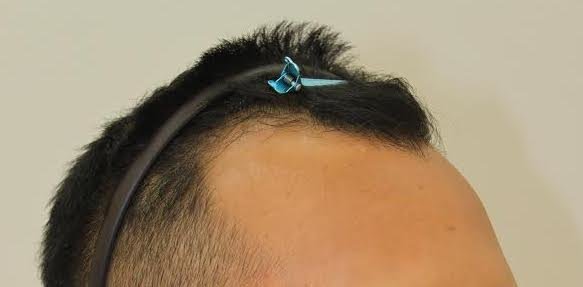 FORHAIR Hair Transplant Korea - FORHAIR Hair Transplant Korea