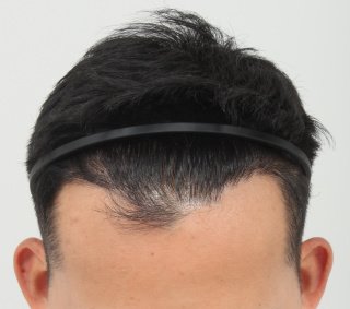 FORHAIR Hair Transplant Korea - FORHAIR Hair Transplant Korea