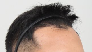 FORHAIR Hair Transplant Korea - FORHAIR Hair Transplant Korea