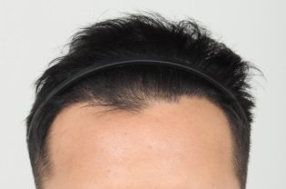 FORHAIR Hair Transplant Korea - FORHAIR Hair Transplant Korea