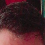 FORHAIR Hair Transplant Korea - FORHAIR Hair Transplant Korea