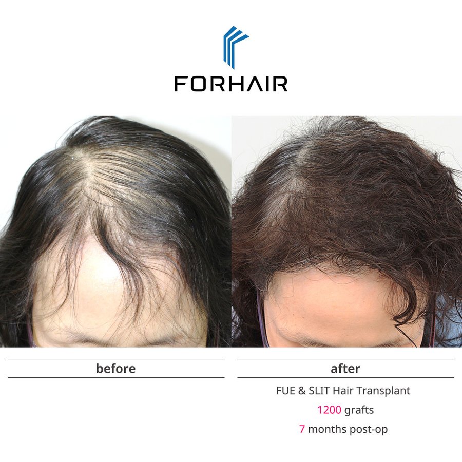 FORHAIR Hair Transplant Korea - FORHAIR Hair Transplant Korea