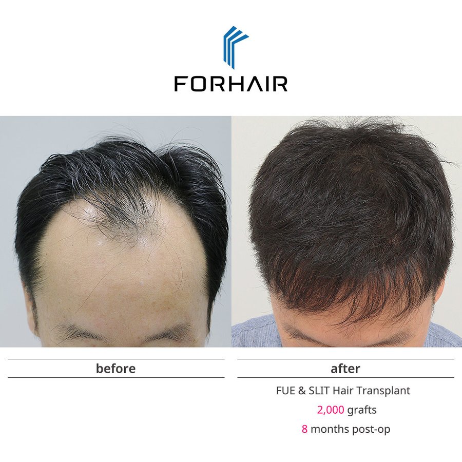 FORHAIR Hair Transplant Korea - FORHAIR Hair Transplant Korea